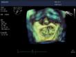 Live 3D TEE enables 3D visualization of the cardiac structure and function as well as new perspectives of the heart in real time, enabling better patient care